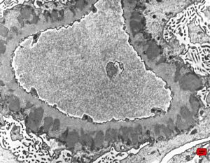 M,60y. | membranous glomerulopathy M,60y. | membranous glomerulopathy